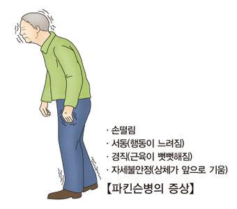 손 떨림, 단순한 노화 아니다…당신도 ‘파킨슨병 전조’일 수 있다 기사 이미지