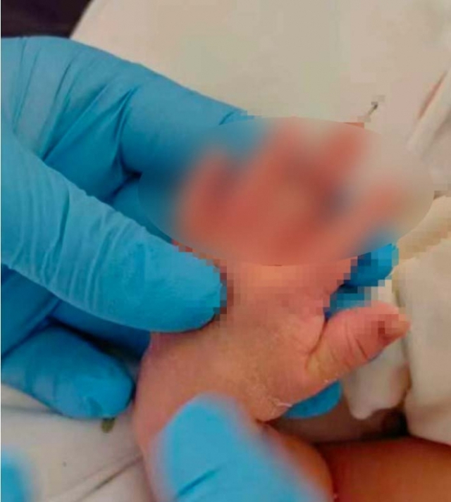 신생아 손가락 절단 ‘의료참사’…중국 병원 관리 부실 논란 확산 기사 이미지