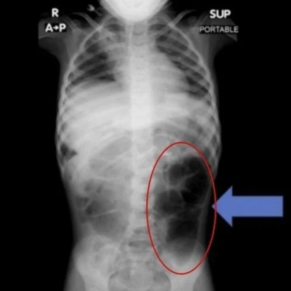 “배가 너무 아파요”…6세 여아 위장 속 ‘머리카락 덩어리’, 라푼젤 증후군 진단 기사 이미지